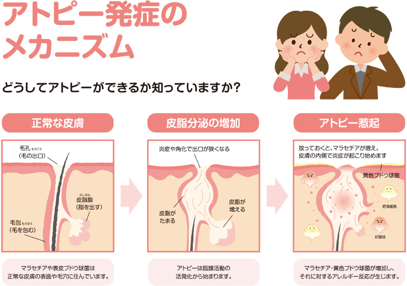 アトピー発症の原因 前編 アトピー脱ステロイド専門入院自然療法 ナチュラルクリニック21