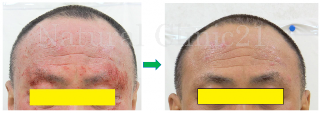 長年の自宅療養から入院を決意し２ヶ月で改善 入院期間 19年5月 6月 症例41 アトピー 脱ステロイド専門入院自然療法 ナチュラルクリニック21