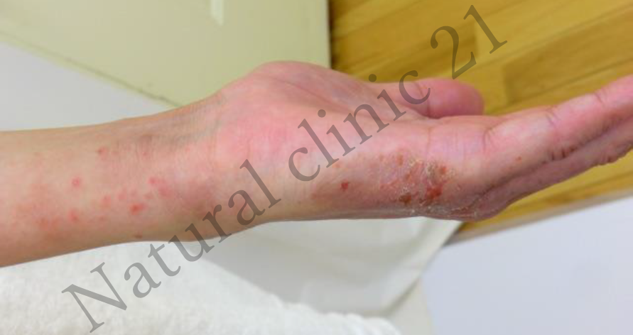 掌の側面の接触皮膚炎