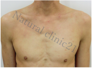 強い痒みに悩まされた痒疹 脱ステロイドのリバウンドを乗り越えて改善 症例 56 アトピー脱ステロイド専門入院自然療法 ナチュラルクリニック21