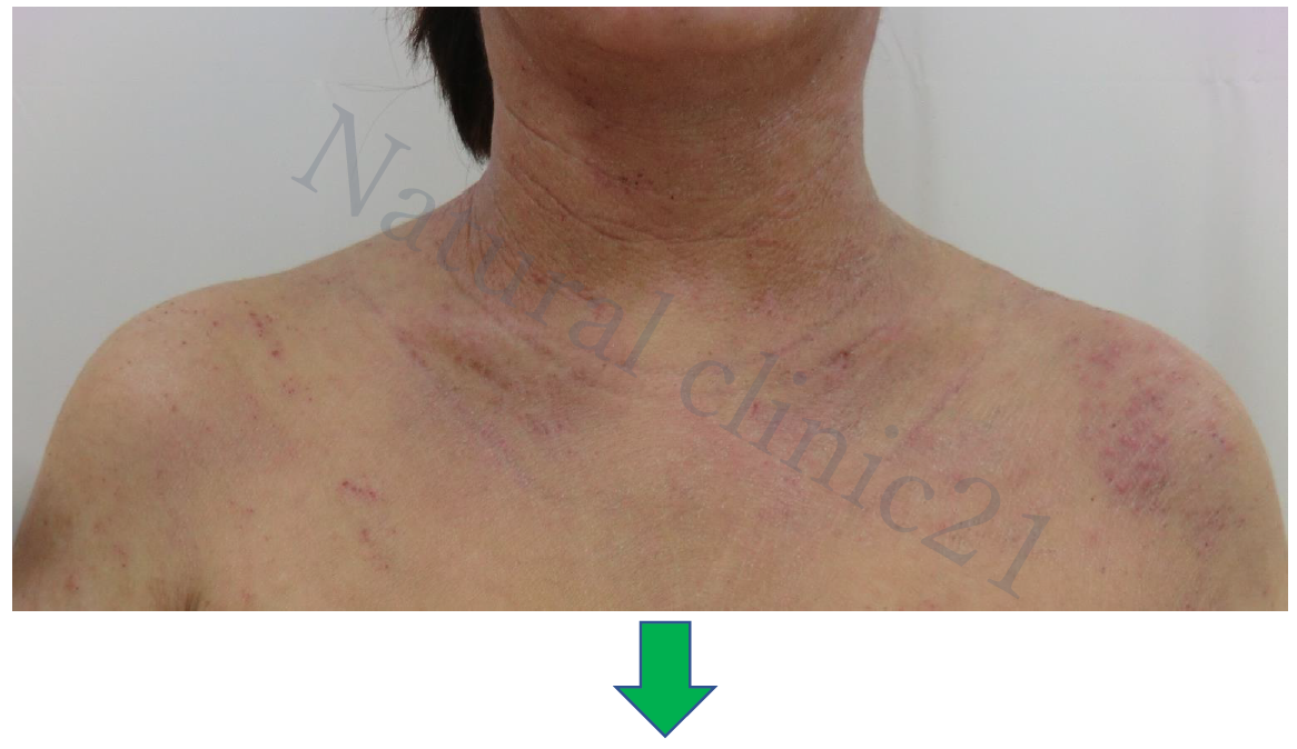 涙の診察から3ヶ月 健やかな肌と笑顔を取り戻した 症例 57 アトピー脱ステロイド専門入院自然療法 ナチュラルクリニック21