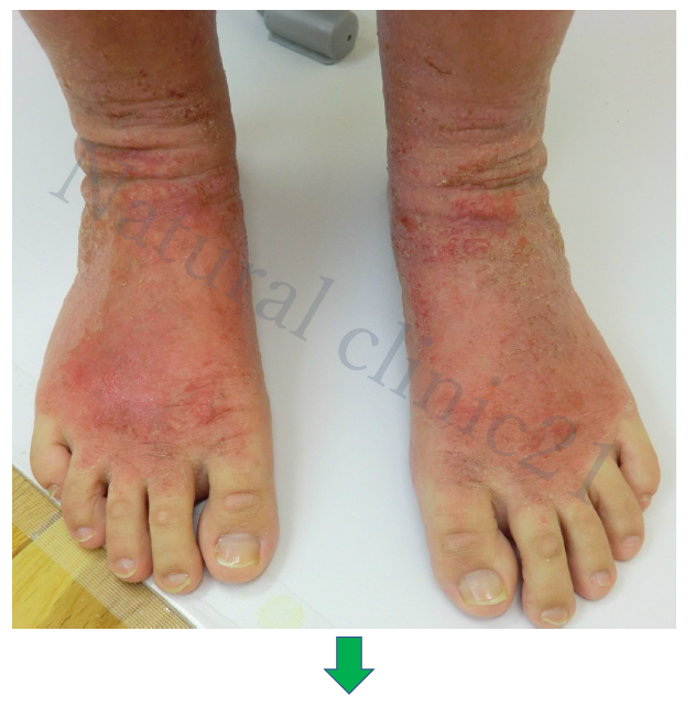 歩くのもつらい皮膚炎が入院3週間でスポーツを楽しめるまで改善 症例 59 アトピー脱ステロイド専門入院自然療法 ナチュラルクリニック21