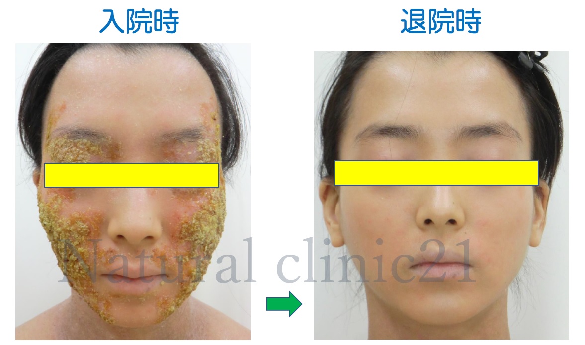 滲出液の黄色いかさぶたが消え見違える肌を取り戻した女性 症例 70 アトピー脱ステロイド専門入院自然療法 ナチュラルクリニック21